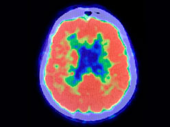 PET  (POSITRON EMISSION TOMOGRAPHY)